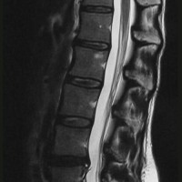 MRI Of Herniated Disc (HNP)