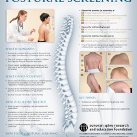 Scoliosis Poster Available To Healthcare-professionals For Scoliosis Screening