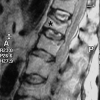 Xray Of Vertebral Fracture Due To Osteoporosis